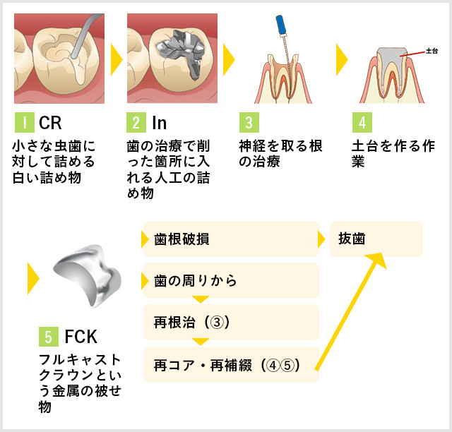 虫歯の状態や段階に応じた治療