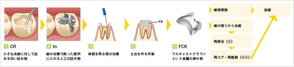 虫歯の状態や段階に応じた治療